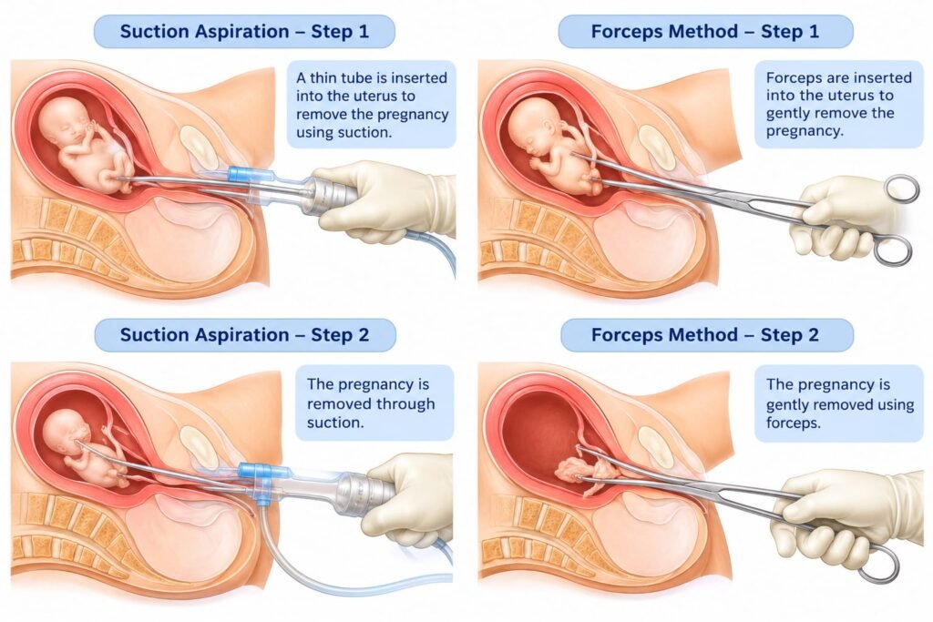 Medical illustration comparing suction aspiration and forceps methods of surgical abortion.